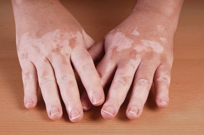 vitiligo kan läka