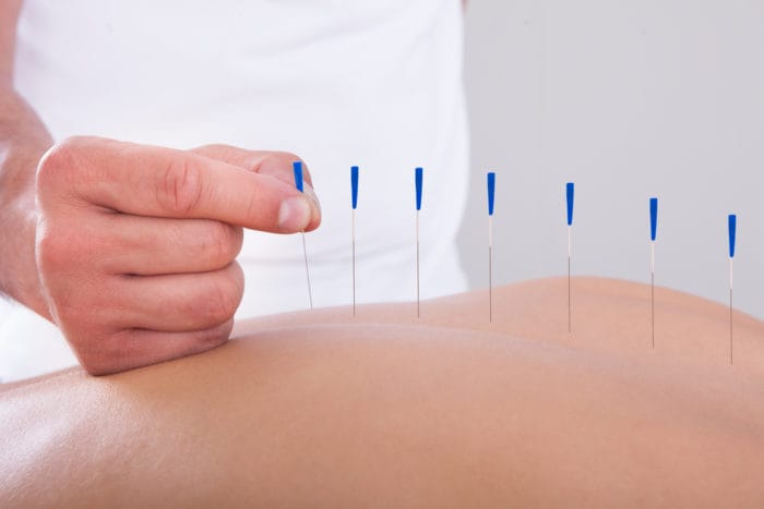 akupunktur lindrar smärta