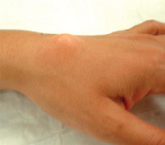 Övre handledspole ganglioncyst (källa: American Society for Hand surgery)