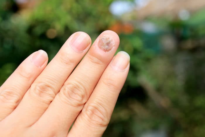 svampinfektion i nageln