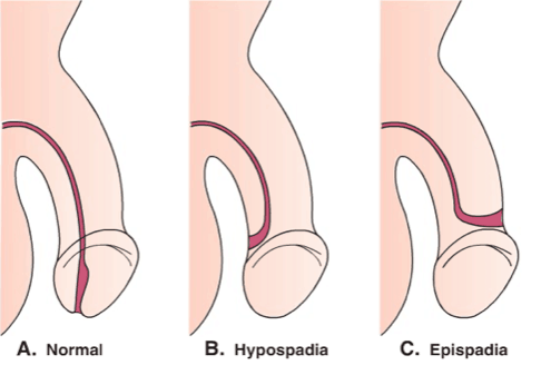 penishålet är inte normalt, episoder av hypospadier
