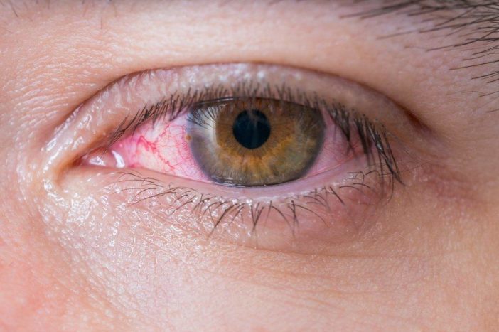allergisk röda ögon-konjunktivit
