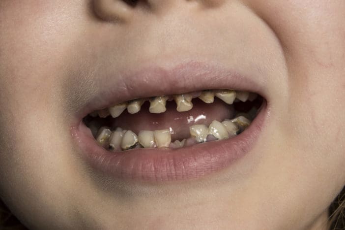 barnflaska tandförfall för barns rubbning