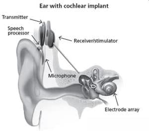cochleär implantatanordning