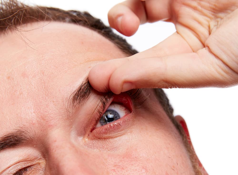 floppy eyelids drooping eyelid syndrome