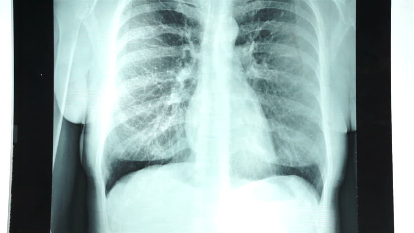 röntgen i bröstet