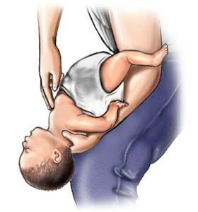 Steg för att hjälpa kvävande barn (4-5) källa: www.webmd.com