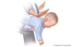 Steg för att hjälpa kvävande barn (1-3): www.webmd.com