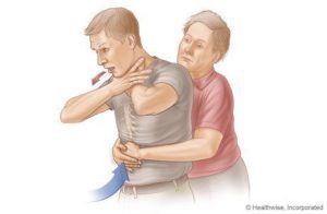 Steg för att hjälpa kvävande personer (källa: webmd.com)