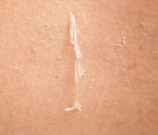 orsaker till att övervinna skinnande hud