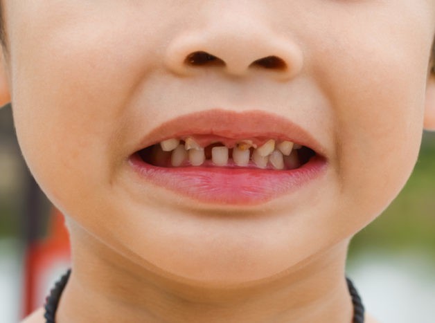 skada på barns tänder