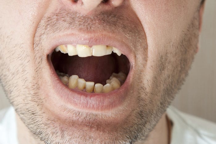 hur man förhindrar tandsten